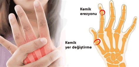 Ellerin eklemlerinde ağrı olması durumunda hangi merhemler ağrıyı hafifletir